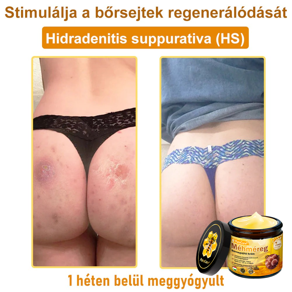 ✨ 𝐏𝐮𝐫𝐚𝐂𝐮𝐫𝐞® 𝐌é𝐡𝐦é𝐫𝐞𝐠 𝐁ő𝐫 𝐇𝐞𝐥𝐲𝐫𝐞á𝐥𝐥í𝐭ó 𝐊𝐫é𝐦 (👨‍⚕‍𝐂𝐄 𝐓𝐚𝐧ú𝐬í𝐭𝐯á𝐧𝐲)👍✅